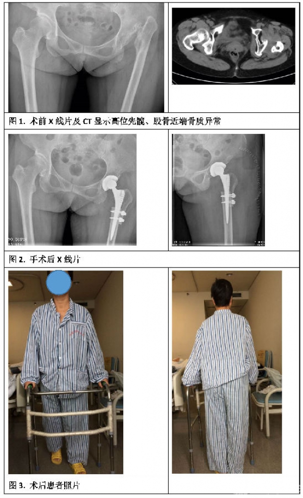 鼓楼医院关节外科翁文杰团队运用Paavilainen技术成功治疗一例复杂髋关节发育不良_页面_2.jpg