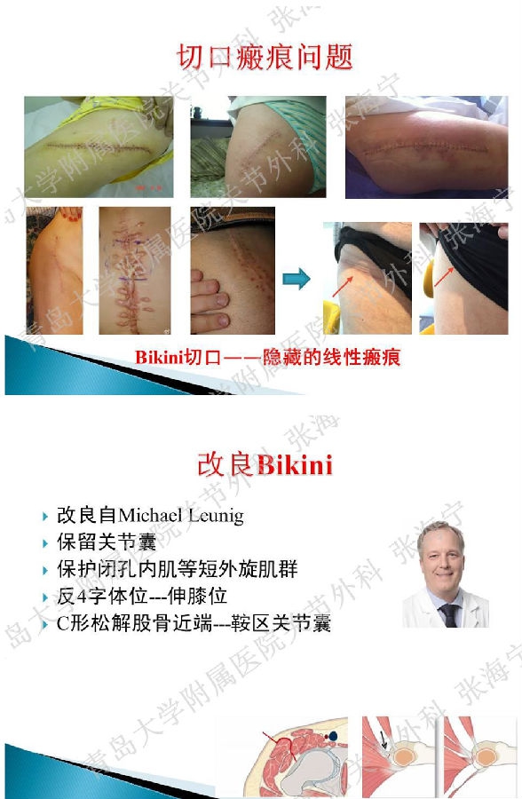 比基尼入路微创人工全髋关节置换术_页面_06.png