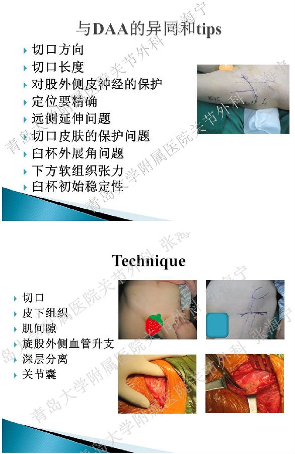 比基尼入路微创人工全髋关节置换术_页面_07.png