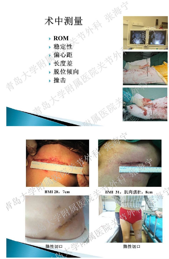 比基尼入路微创人工全髋关节置换术_页面_09.png