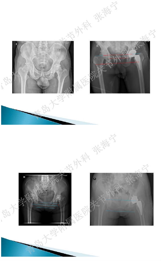 比基尼入路微创人工全髋关节置换术_页面_10.png