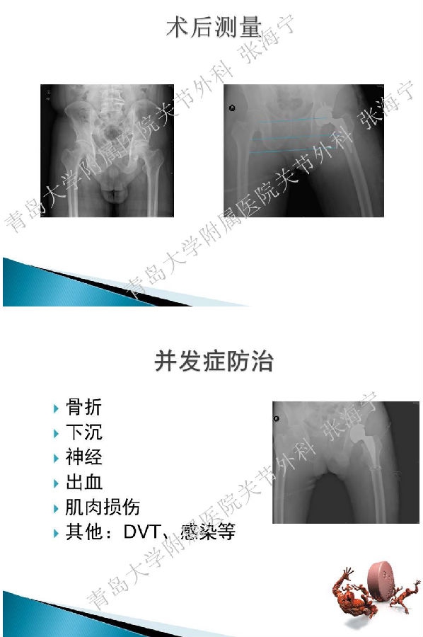 比基尼入路微创人工全髋关节置换术_页面_11.png