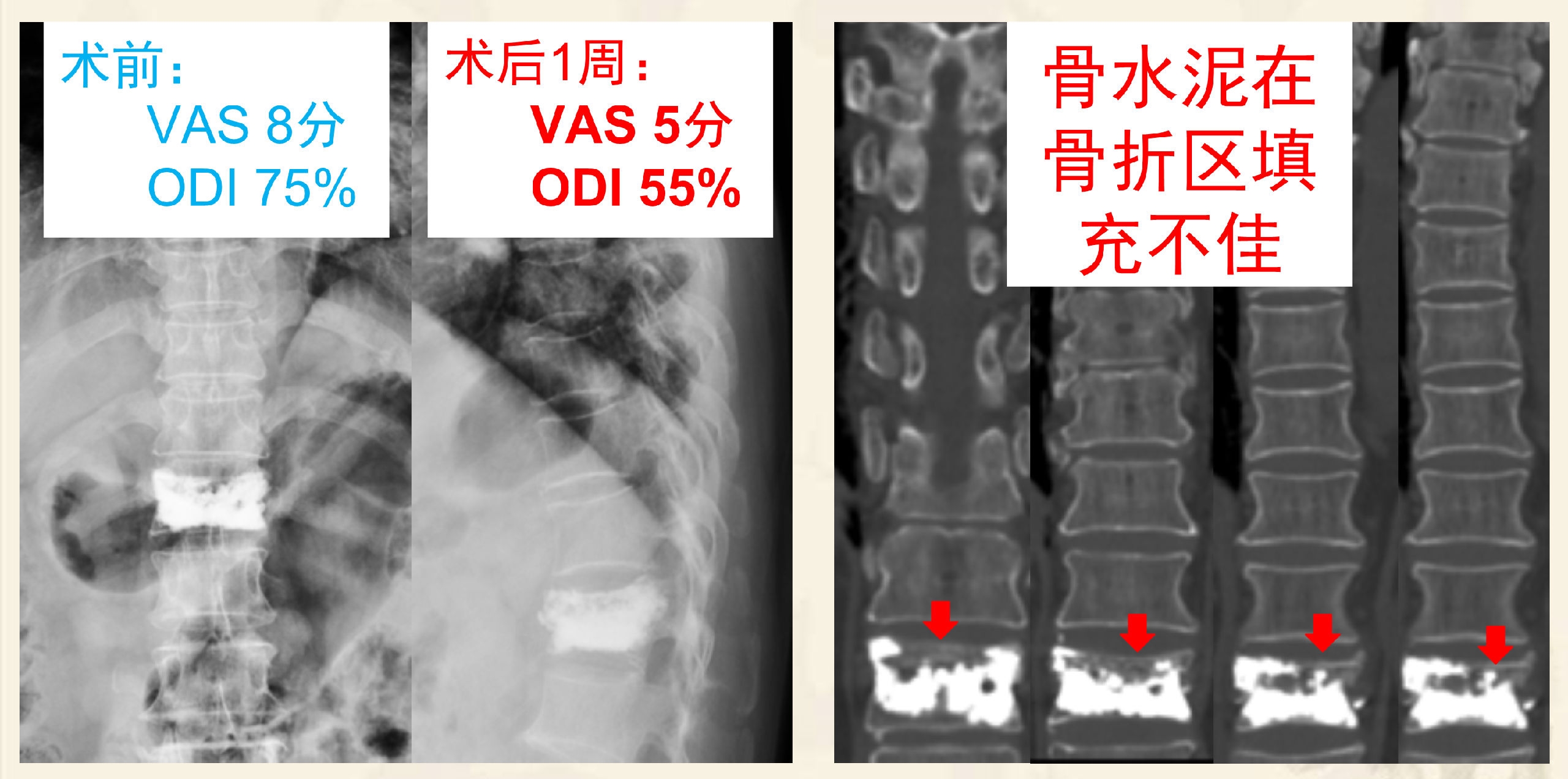 靶向锚定式椎体成形术 完整版(1)_3.png