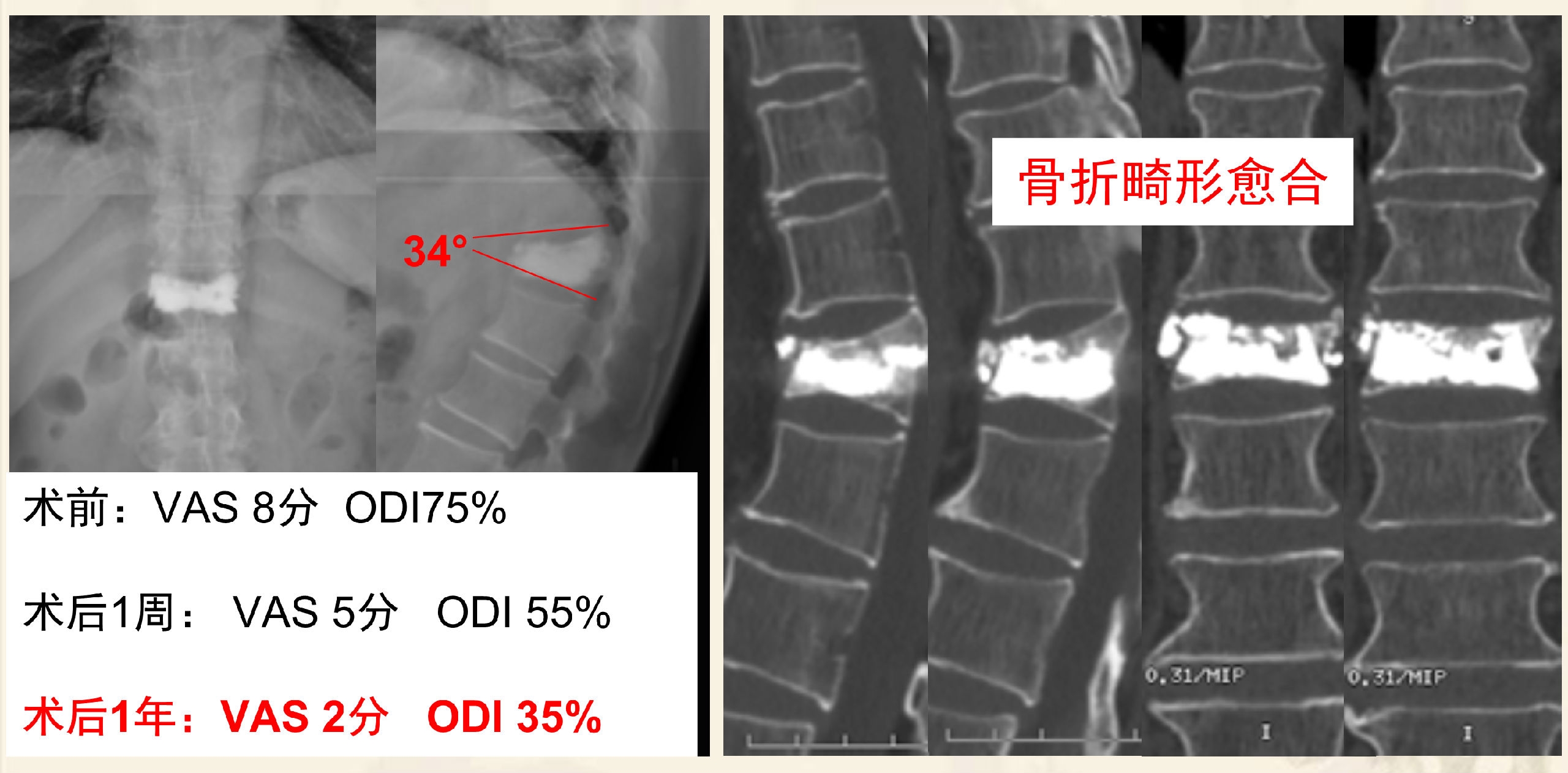 靶向锚定式椎体成形术 完整版(1)_4.png
