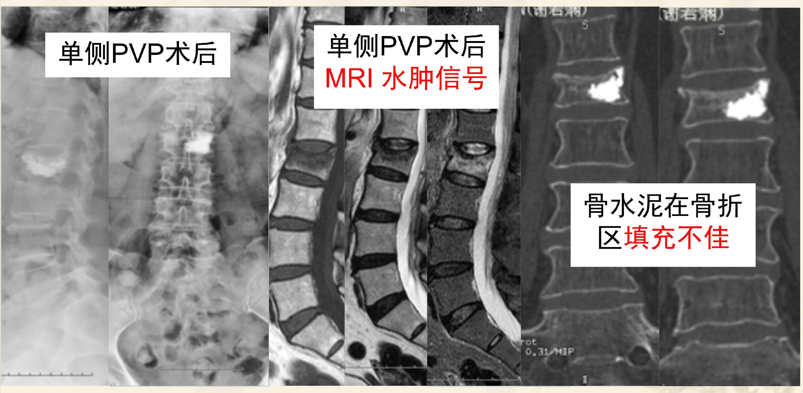 靶向锚定式椎体成形术 完整版(1)_5.png