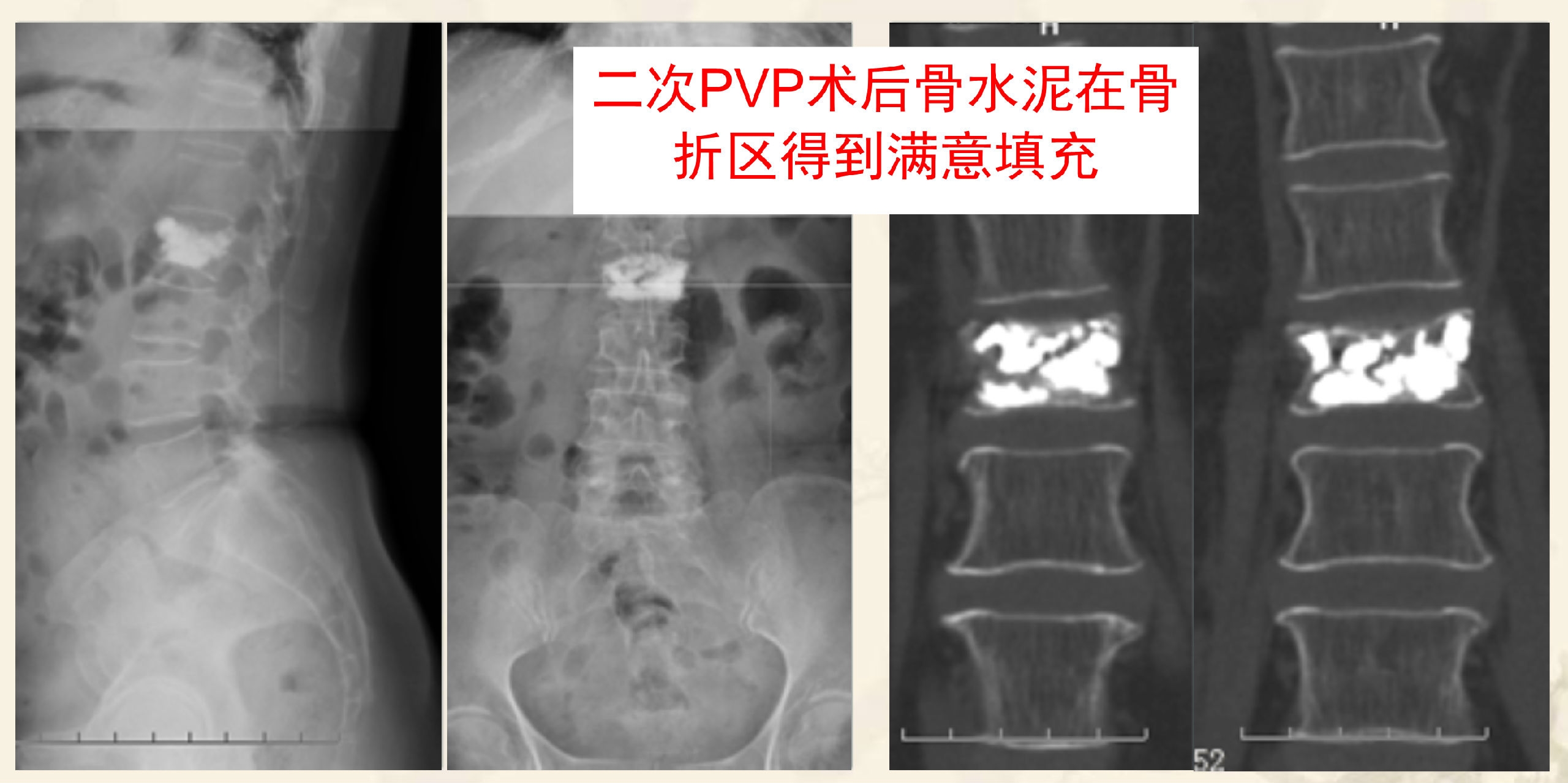 靶向锚定式椎体成形术 完整版(1)_6.png