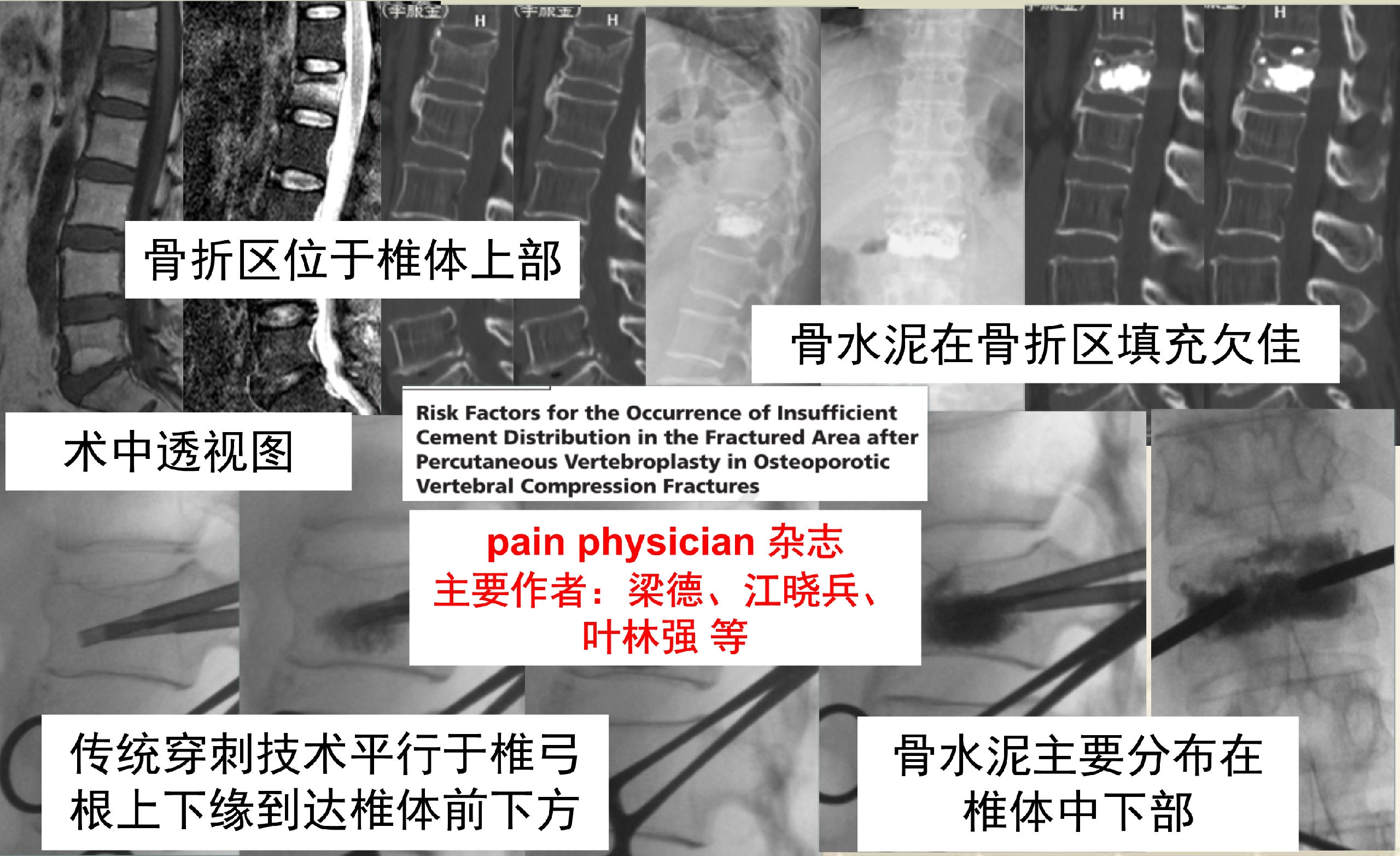 靶向锚定式椎体成形术 完整版(1)_14.png