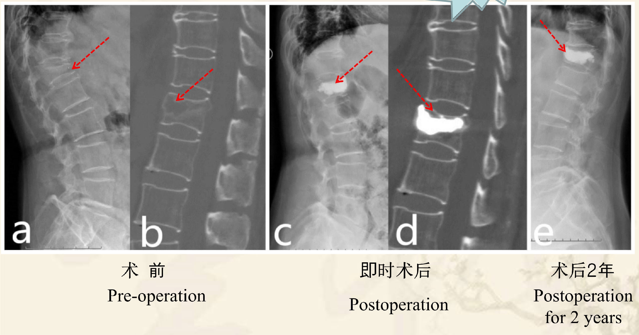 靶向锚定式椎体成形术 完整版(1)_17.png