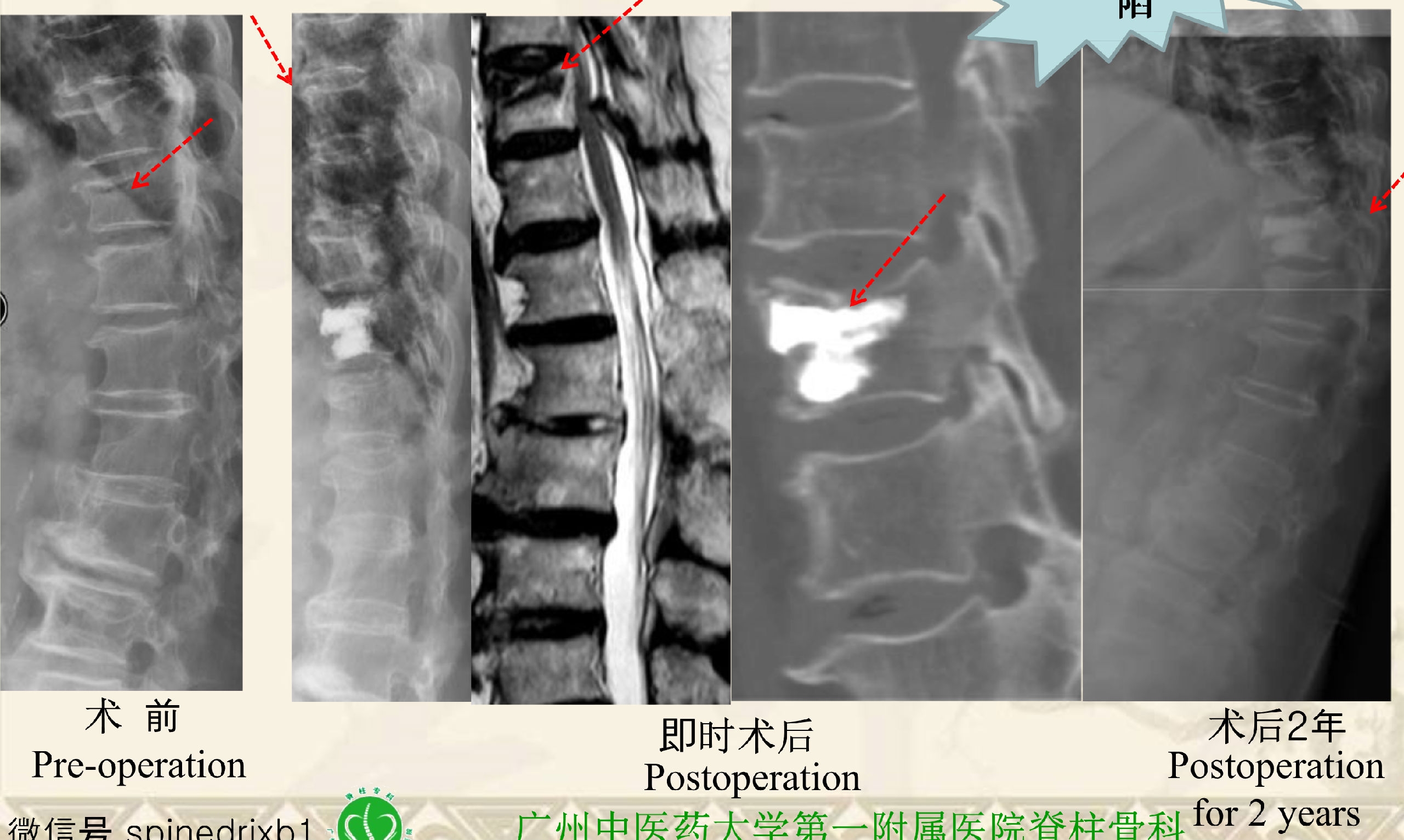 靶向锚定式椎体成形术 完整版(1)_18.png