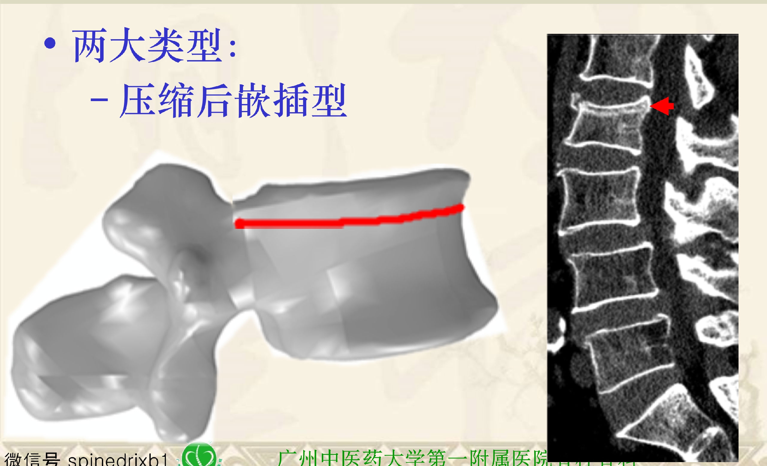 靶向锚定式椎体成形术 完整版(1)_20.png