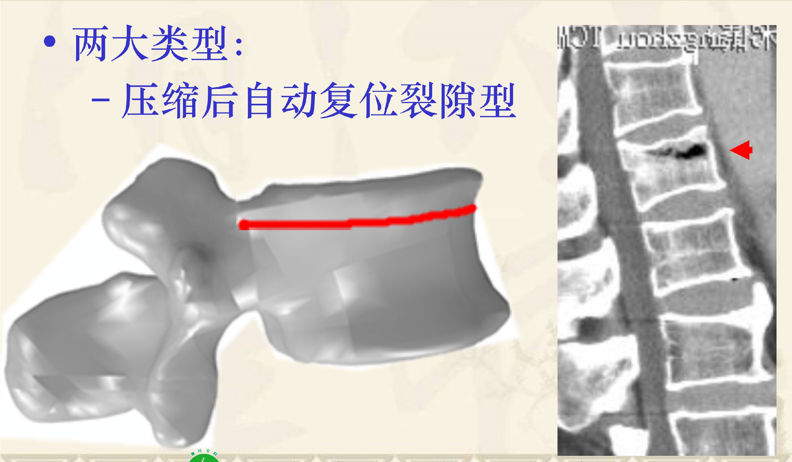 靶向锚定式椎体成形术 完整版(1)_21.png