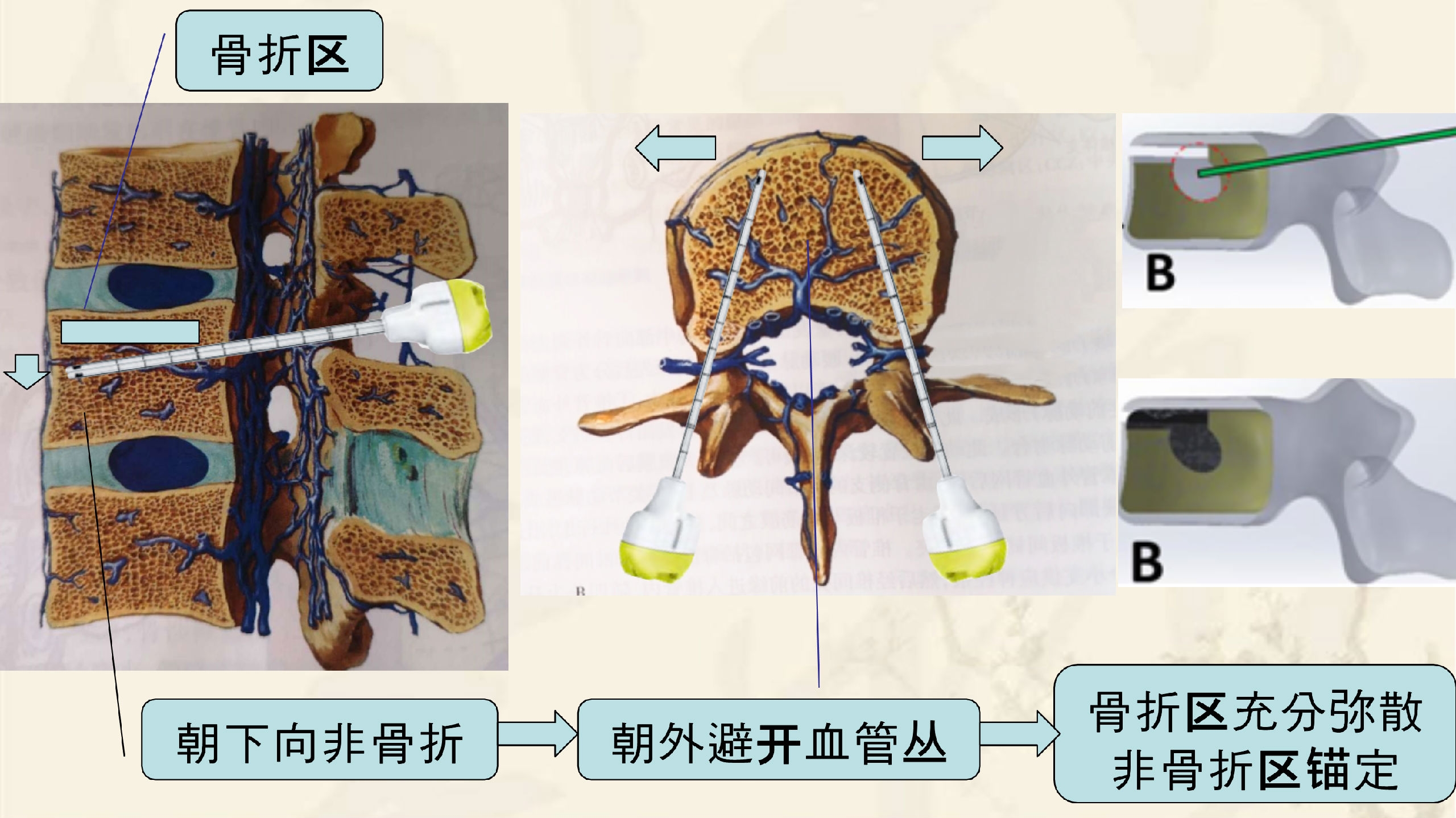 靶向锚定式椎体成形术 完整版(1)_27.png