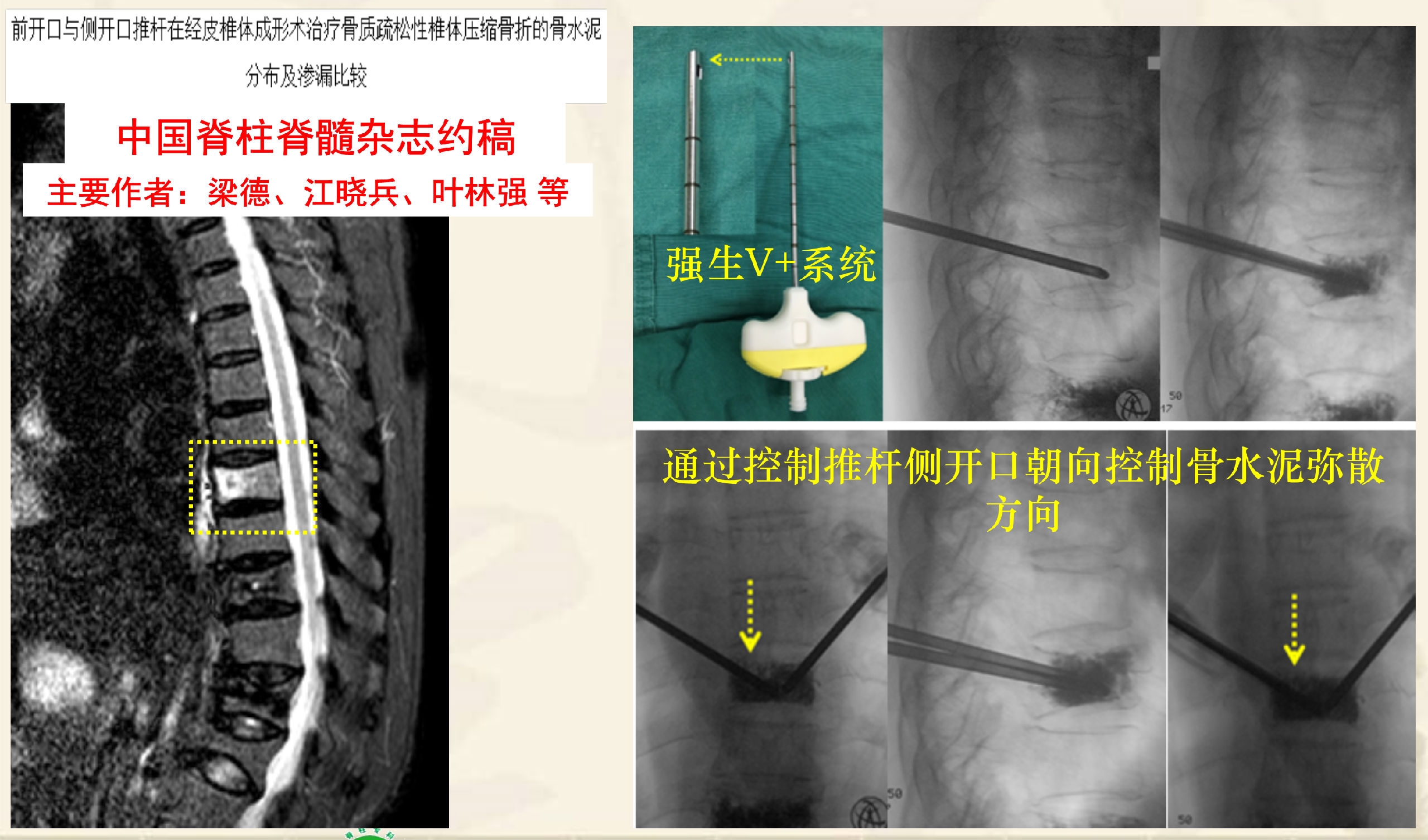 靶向锚定式椎体成形术 完整版(1)_44.png