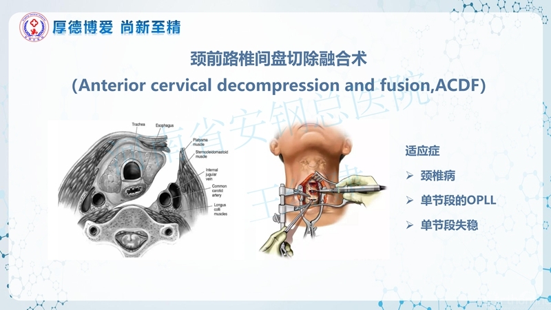 Endo-Assisted-ACDF技术流程与体会_01.jpg