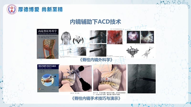 Endo-Assisted-ACDF技术流程与体会_07.jpg