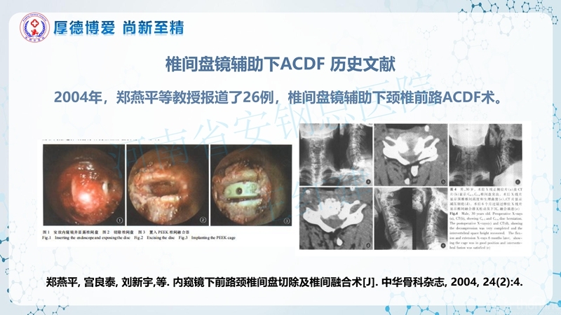Endo-Assisted-ACDF技术流程与体会_10.jpg