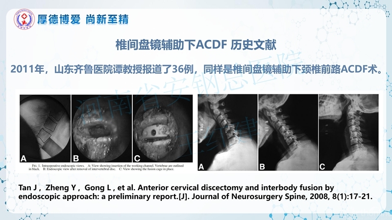Endo-Assisted-ACDF技术流程与体会_11.jpg
