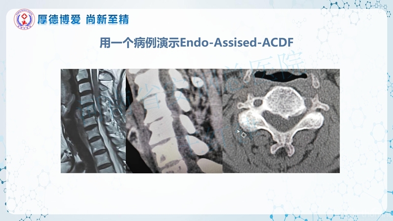 Endo-Assisted-ACDF技术流程与体会_18.jpg