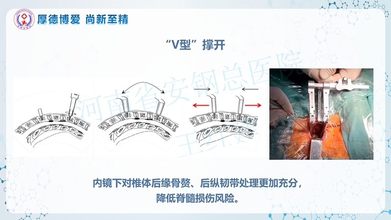 Endo-Assisted-ACDF技术流程与体会_21.jpg