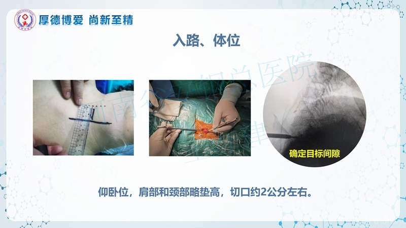Endo-Assisted-ACDF技术流程与体会_20.jpg