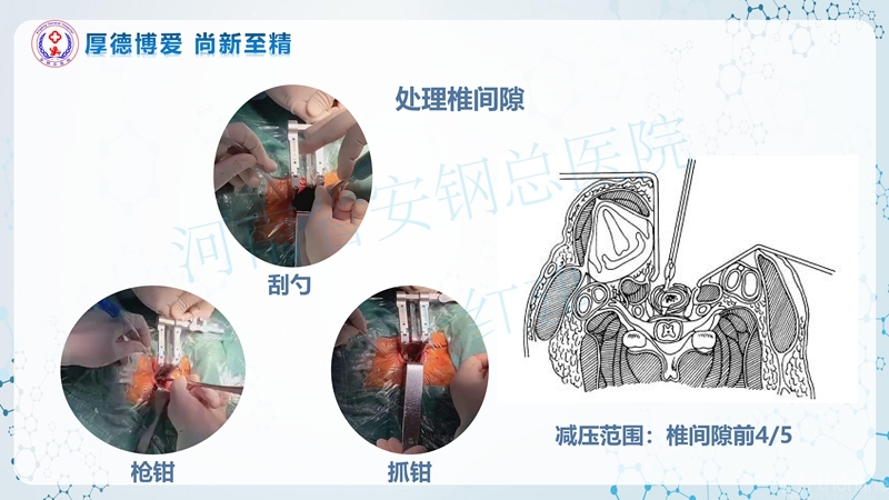 Endo-Assisted-ACDF技术流程与体会_23.jpg