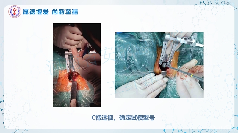 Endo-Assisted-ACDF技术流程与体会_24.jpg