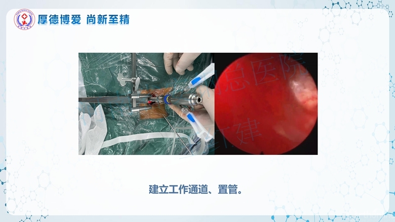 Endo-Assisted-ACDF技术流程与体会_26.jpg