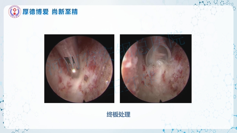 Endo-Assisted-ACDF技术流程与体会_27.jpg