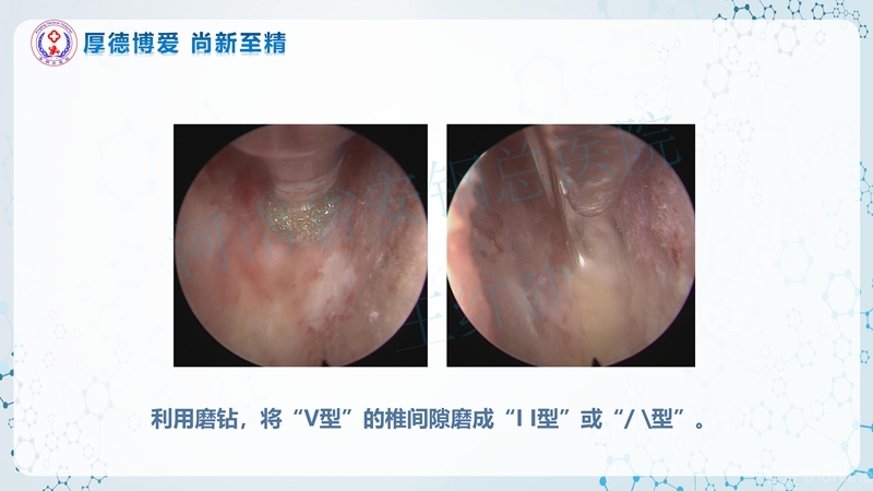 Endo-Assisted-ACDF技术流程与体会_28.jpg