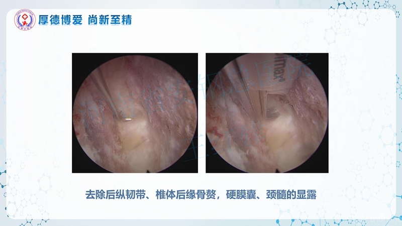Endo-Assisted-ACDF技术流程与体会_29.jpg