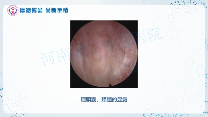 Endo-Assisted-ACDF技术流程与体会_30.jpg
