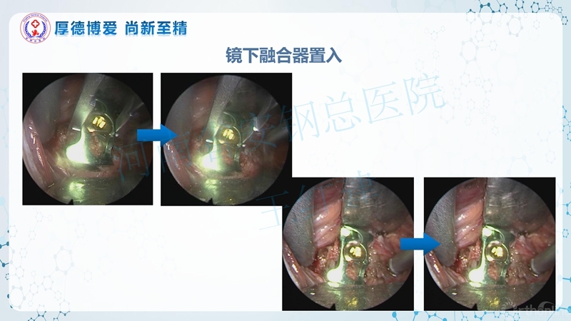 Endo-Assisted-ACDF技术流程与体会_32.jpg