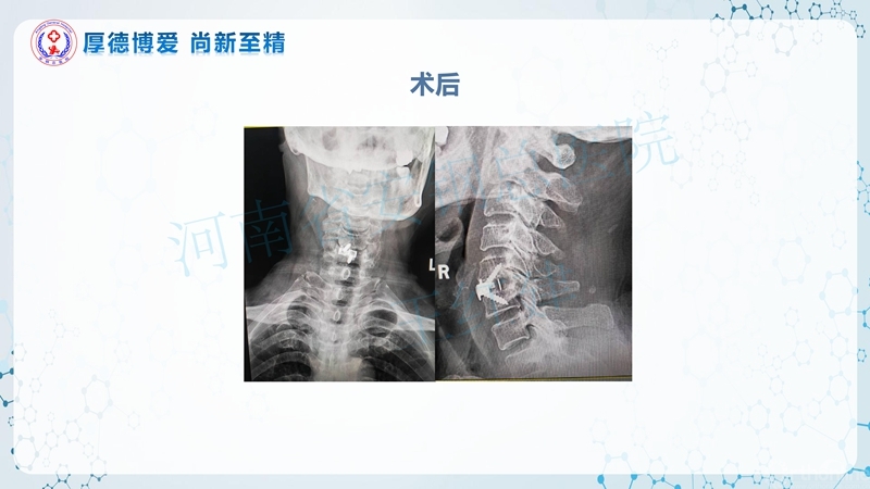 Endo-Assisted-ACDF技术流程与体会_34.jpg