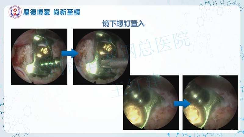 Endo-Assisted-ACDF技术流程与体会_33.jpg