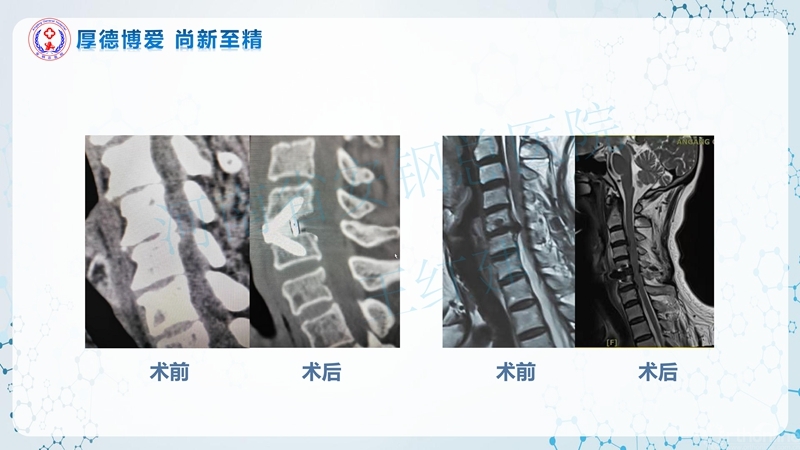 Endo-Assisted-ACDF技术流程与体会_35.jpg