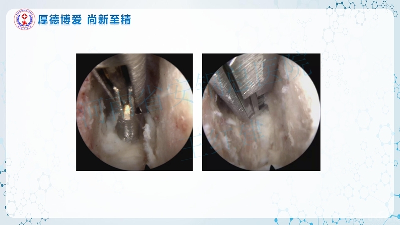 Endo-Assisted-ACDF技术流程与体会_37.jpg