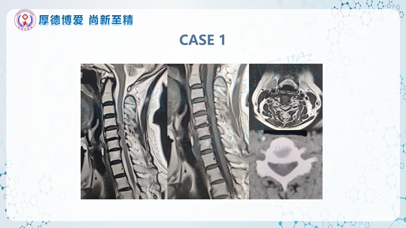 Endo-Assisted-ACDF技术流程与体会_36.jpg