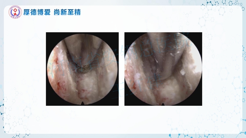 Endo-Assisted-ACDF技术流程与体会_38.jpg