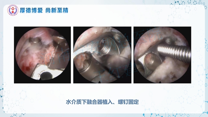 Endo-Assisted-ACDF技术流程与体会_39.jpg