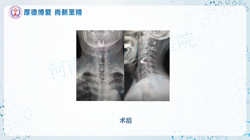 Endo-Assisted-ACDF技术流程与体会_40.jpg