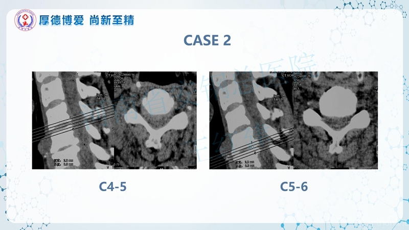 Endo-Assisted-ACDF技术流程与体会_41.jpg