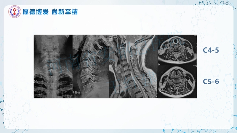 Endo-Assisted-ACDF技术流程与体会_42.jpg
