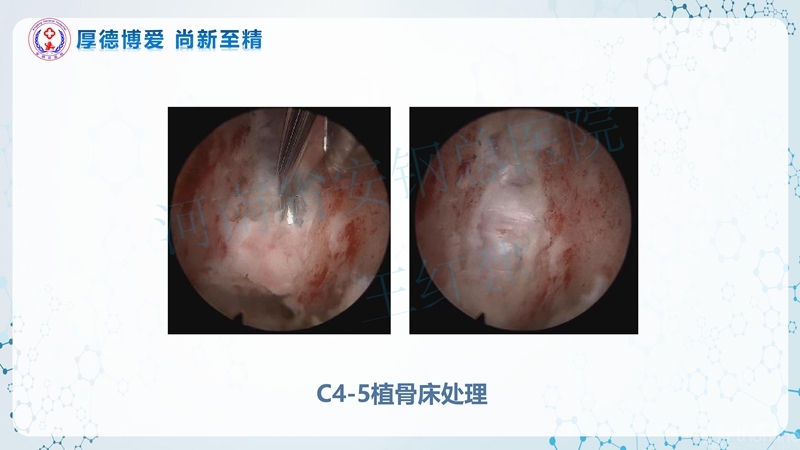 Endo-Assisted-ACDF技术流程与体会_43.jpg