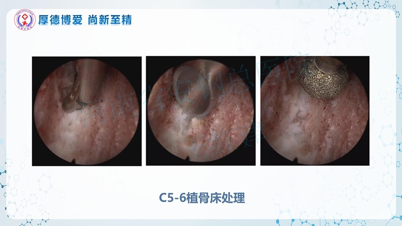 Endo-Assisted-ACDF技术流程与体会_44.jpg