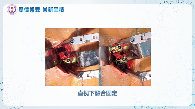Endo-Assisted-ACDF技术流程与体会_45.jpg