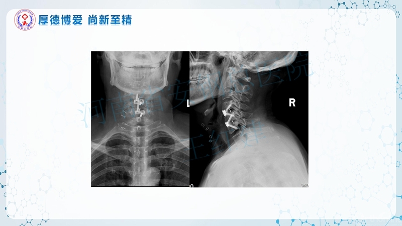 Endo-Assisted-ACDF技术流程与体会_46.jpg