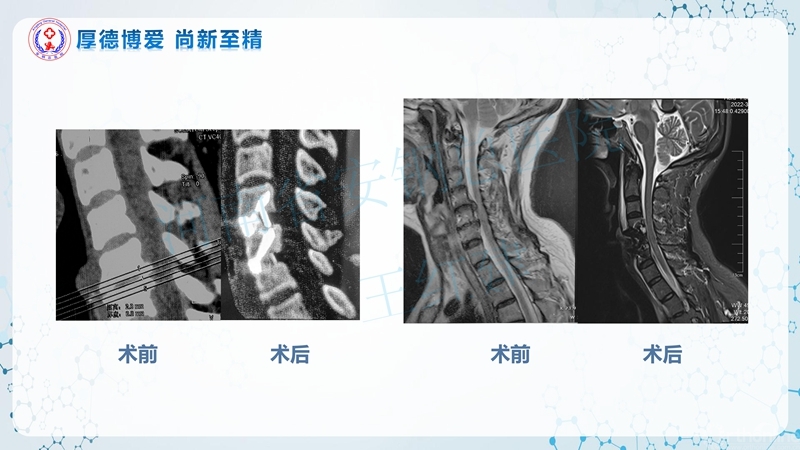 Endo-Assisted-ACDF技术流程与体会_47.jpg