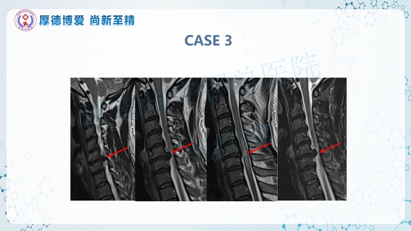 Endo-Assisted-ACDF技术流程与体会_48.jpg
