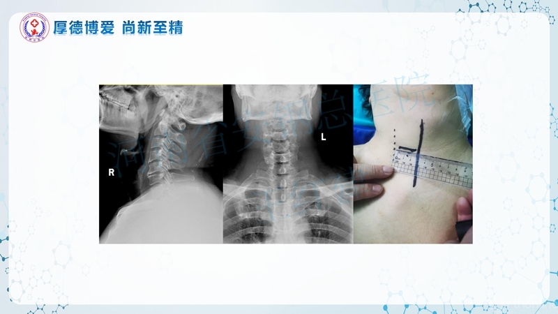 Endo-Assisted-ACDF技术流程与体会_50.jpg