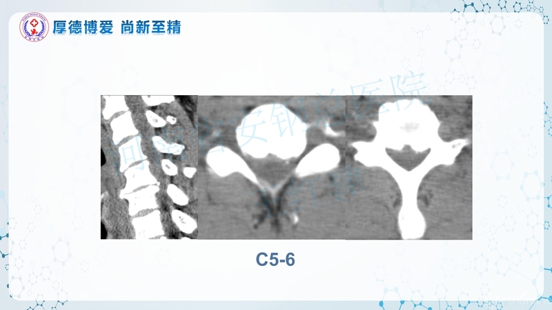 Endo-Assisted-ACDF技术流程与体会_49.jpg